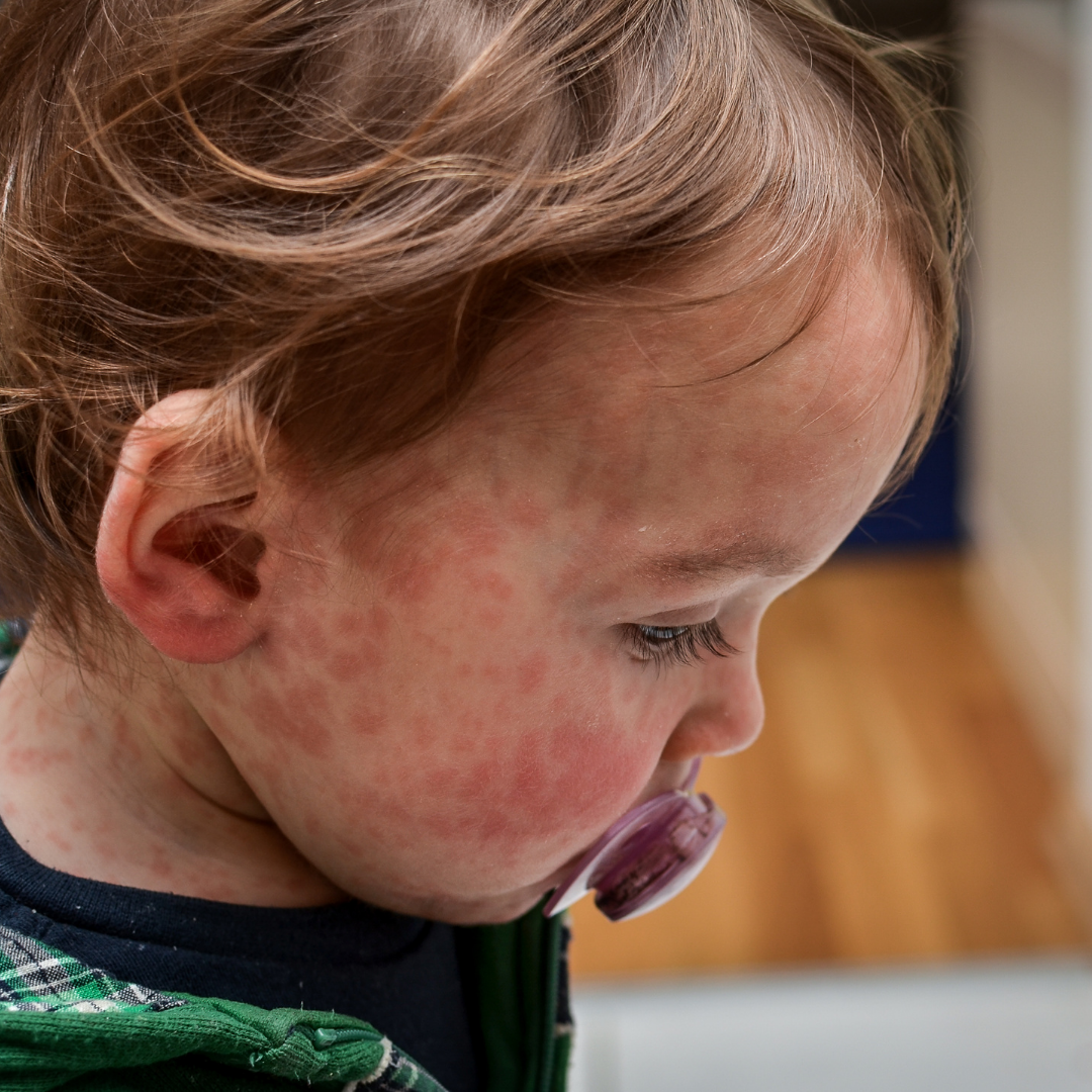 Toddler with red spots on face and neck, holding a pacifier.